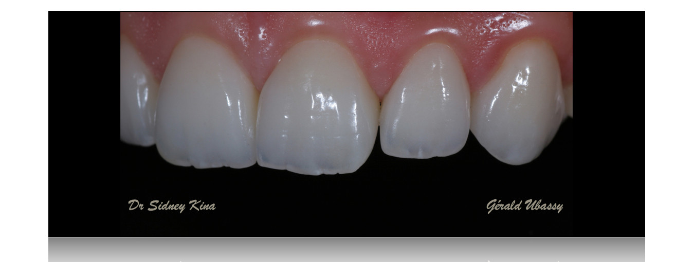 12 Veneers, Kina /Ubassy